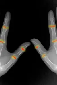 Inherent Developmental Differences Pre-Program Vulnerability to Rheumatoid Arthritis Before Birth, Study Reveals